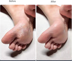 4 Pieces Double Sided Foot File Callus Remover Foot Sander Foot Scrubber Dead - Image 5