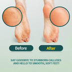Gorgellux Callus Remover Gel, Callus Remover - Image 2