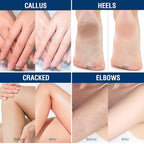 OUKEYA Urea Cream 40 Percent, Foot & Hand Cream - Image 8