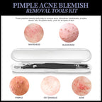 Teenitor Blackhead Remover Tools, Pimple Popper Tool Kit, Ingrown Hair Tweezers - Image 8