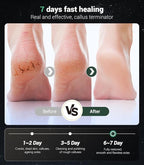 5-in-1 Professional Electric Callus Remover, Removes 99.92% of Calluses in 3 - Image 5