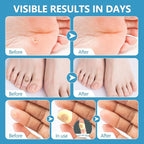Corn removers for Toes feet Bottom of Foot Corn Remover, Corn Pads Callus - Image 6