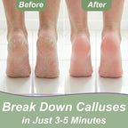 Dr. Entre's 16oz Callus Remover Gel: Extra Strength Value Size, Callus Remover - Image 4
