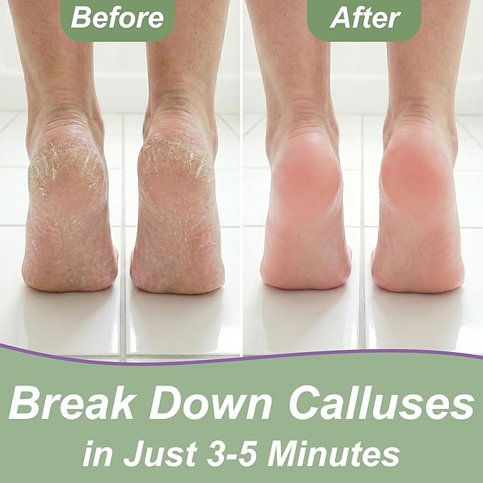 Dr. Entre's Callus Remover Gel: Extra Strength Callus Remover - Image 4