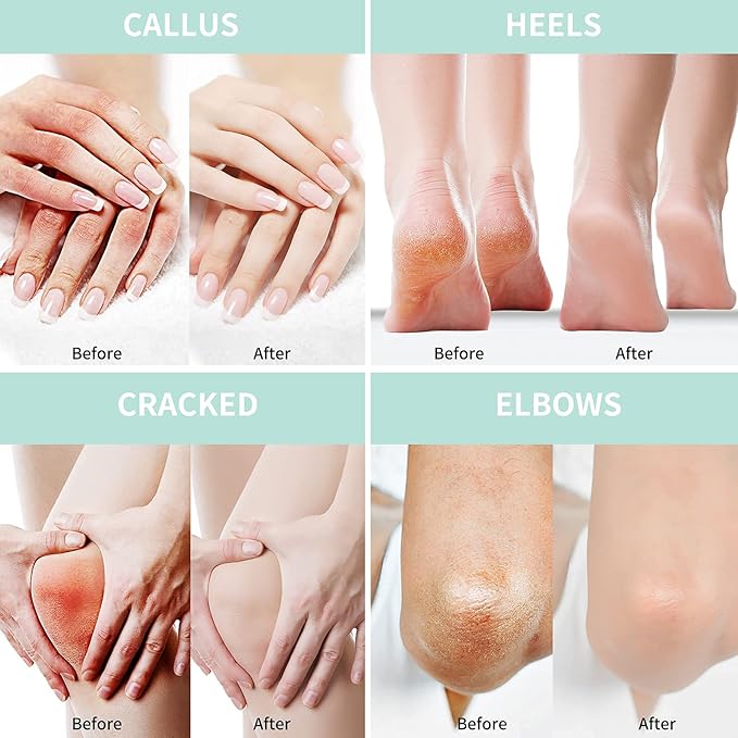 Grocerism 2 Packs Urea Cream 40% Plus 2% Salicylic Acid 5.30 oz || Foot Cream - Image 4