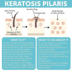 KP Bump Eraser Body Scrub with 10% AHA | Keratosis Pilaris Treatment | Bump - Image 6