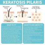 Body Soap for Keratosis Pilaris | Exfoliating Soap Scrub - Image 5