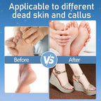 Callus Remover for Feet, Electric Foot Callus Remover Waterproof - Image 7